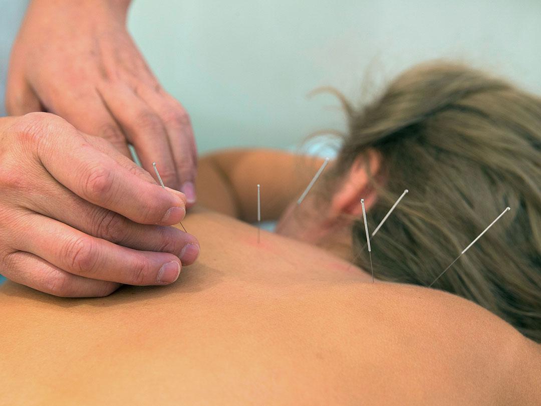 Akupunktur am oberen Rücken einer Patientin